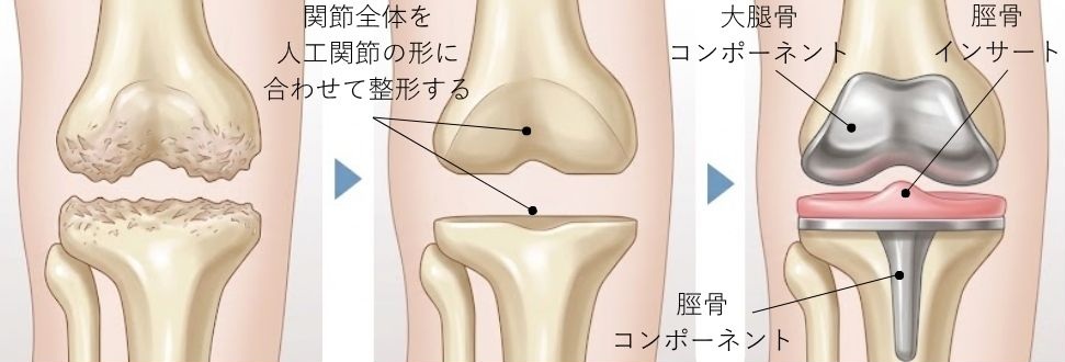 全置換術(TKA)のイラスト図