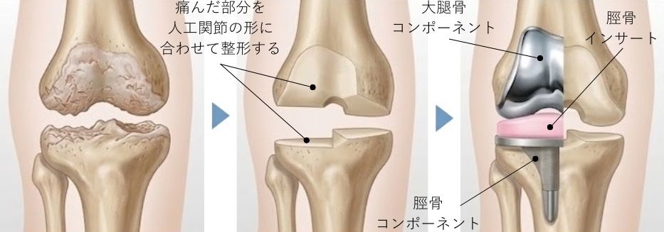 単顆換術(UKA)のイラスト図
