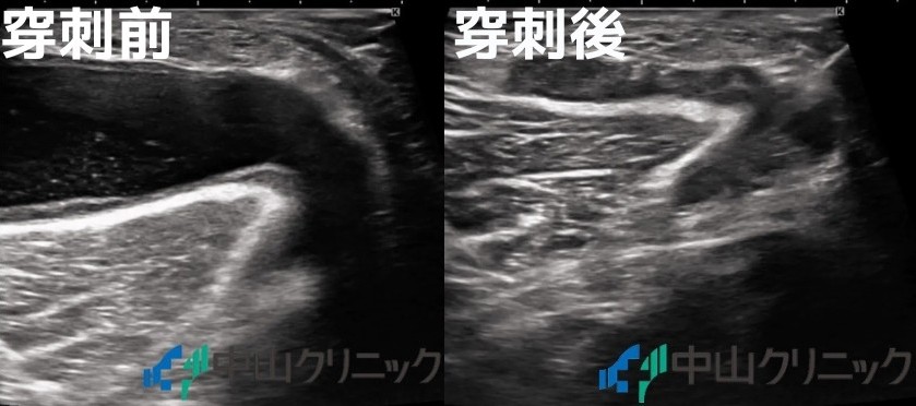 膝関節の水が溜まっている図