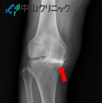 膝関節の隙間がない状態